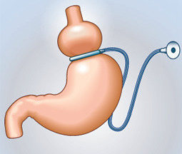 Gastric band drawing